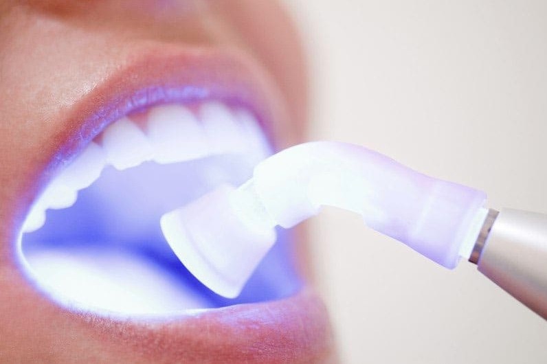 Teeth whitening prices in Parramatta