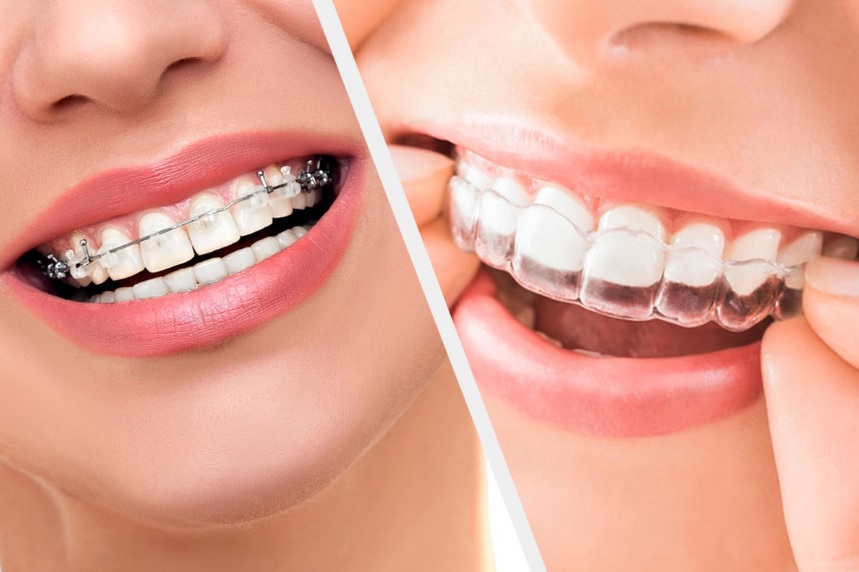 Adult braces in Parramatta