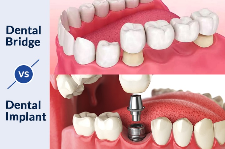 tooth implant vs bridge in Parramatta