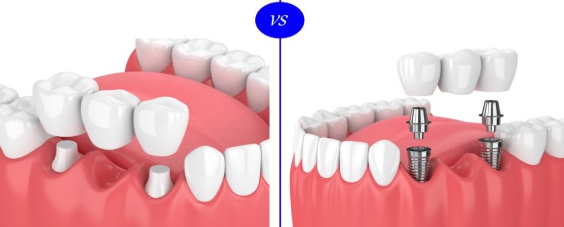 tooth implant vs bridge in Parramatta