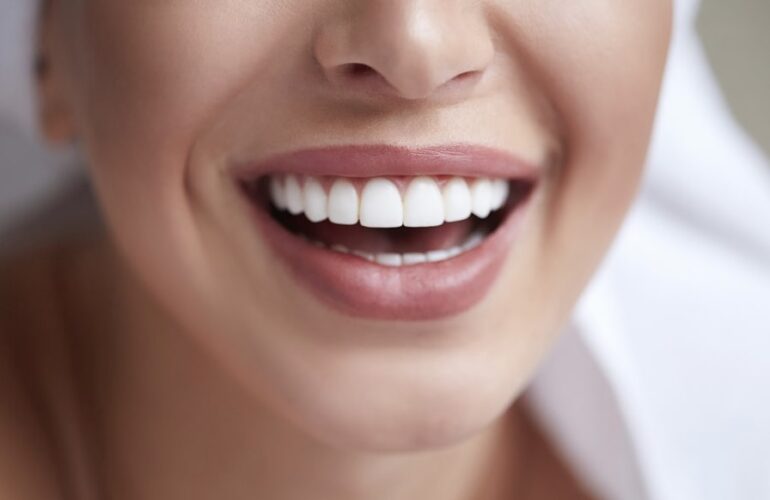 Composite Veneers Sydney