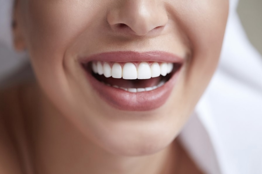 Composite Veneers Sydney