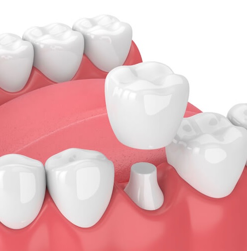 dental crown cost parramatta