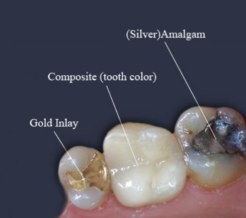 Dental Filling Cost Parramatta