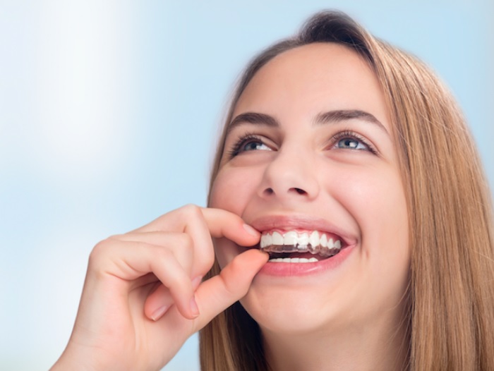 Invisalign cost in Parramatta