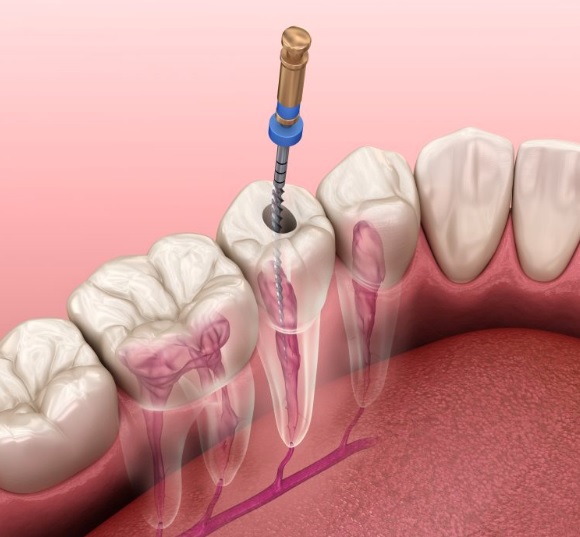 root canal cost sydney