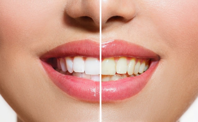 teeth whitening sydney