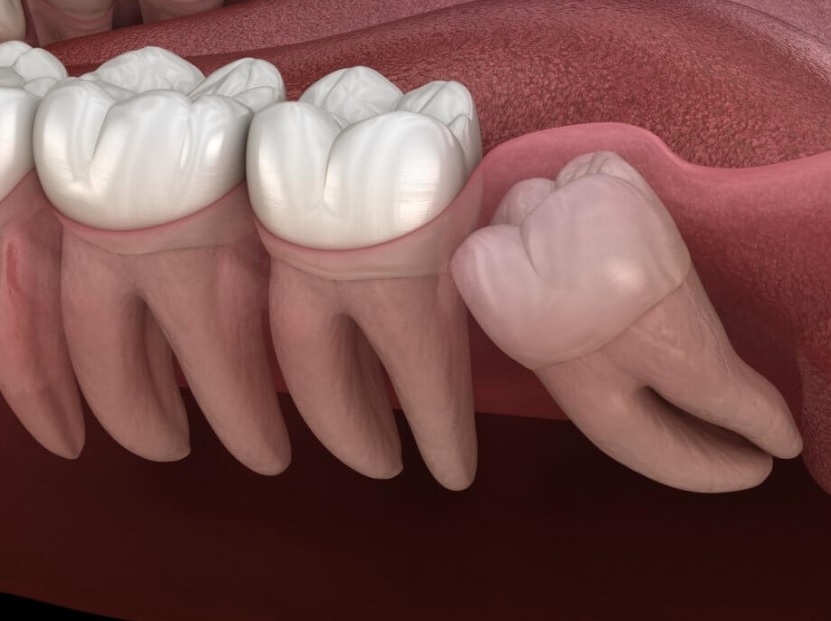 wisdom tooth removal parramatta