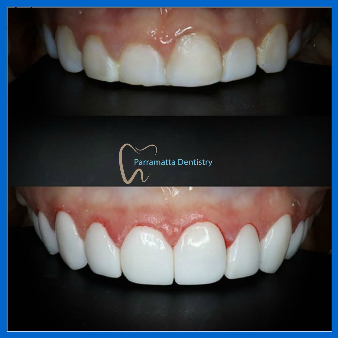 Dental veneers in Parramatta