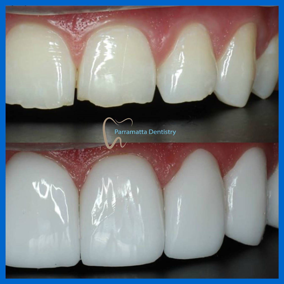 Porcelain veneers in Parramatta