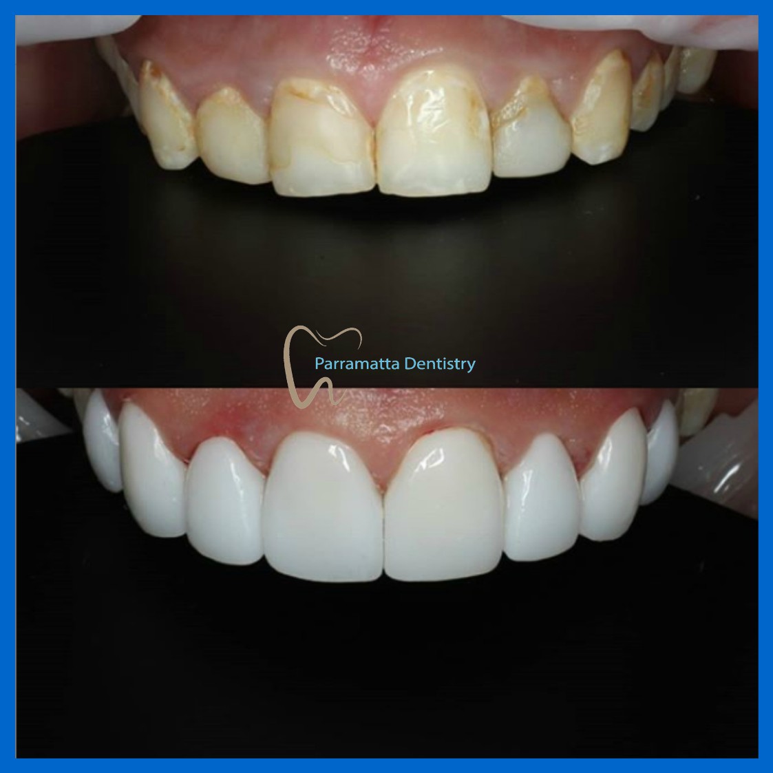 Affordable dental veneers in Parramatta