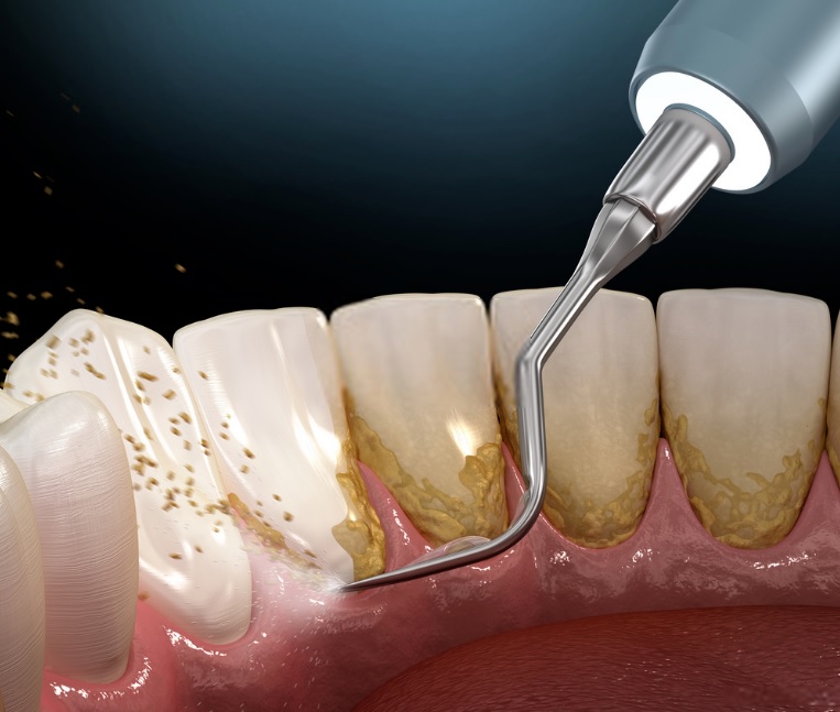 Dental Cleaning Near Me | Dental cleaning