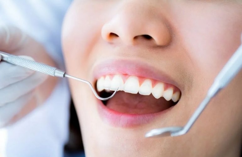 Teeth Cleaning Sydney