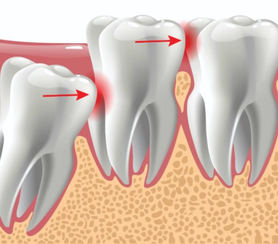 Wisdom Teeth Removal Sydney