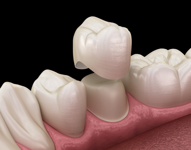 Dental Crown Procedure | Tooth crown
