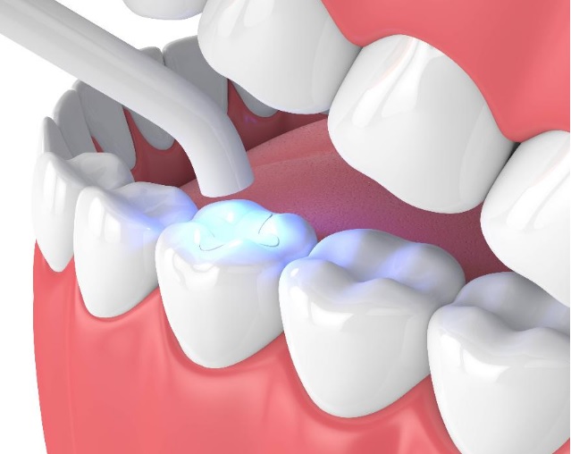 Tooth Filling Cost