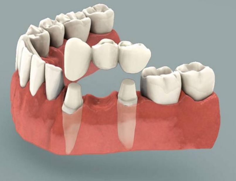 Dental Bridge