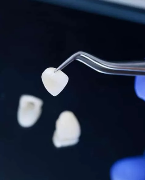 Cost of Dental Veneers | Veneers Cost