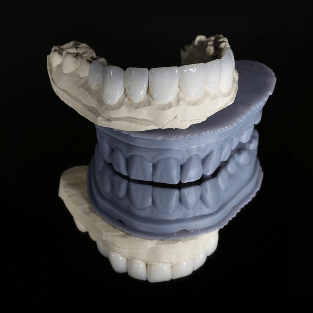 Cost of porcelain veneers at Parramatta Dentistry