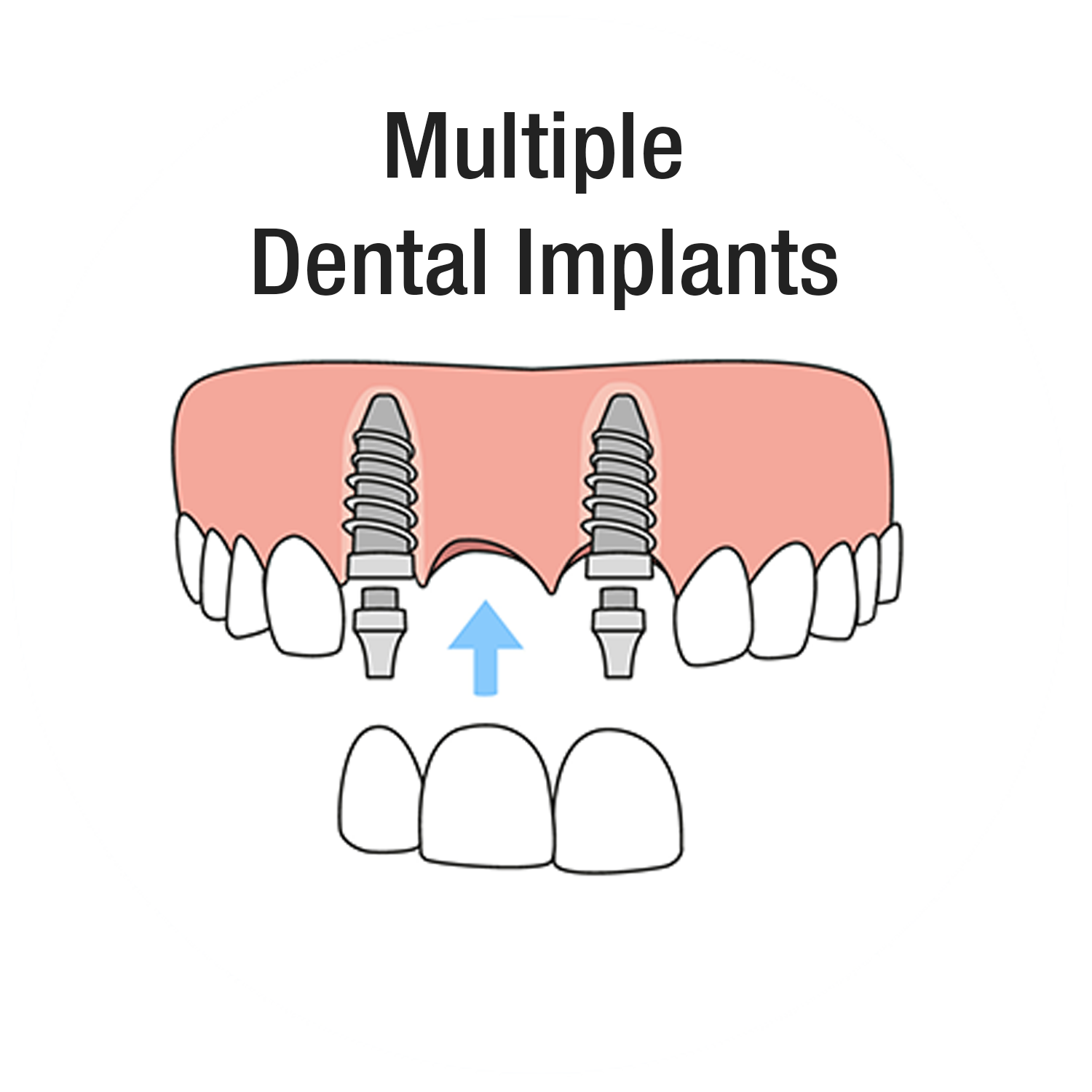 Multiple-Dental-Implants