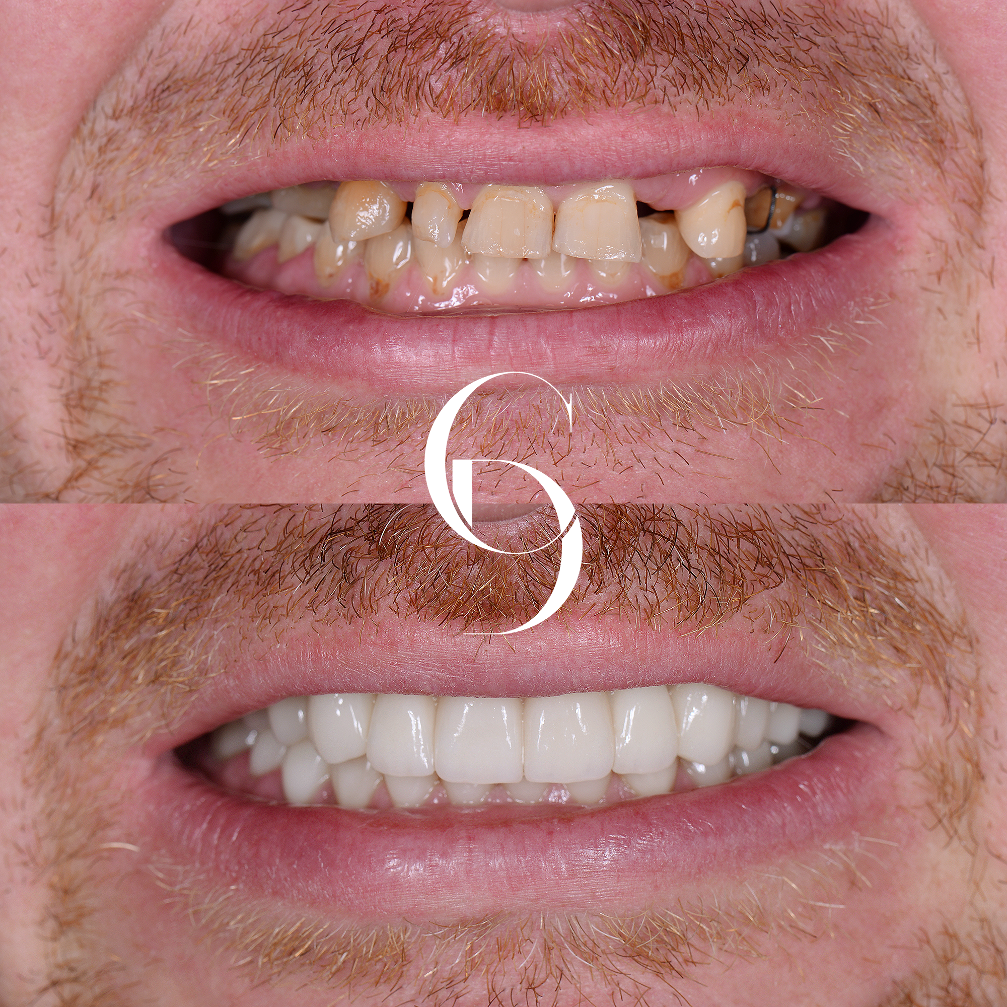 All-on-4 Dental Implants