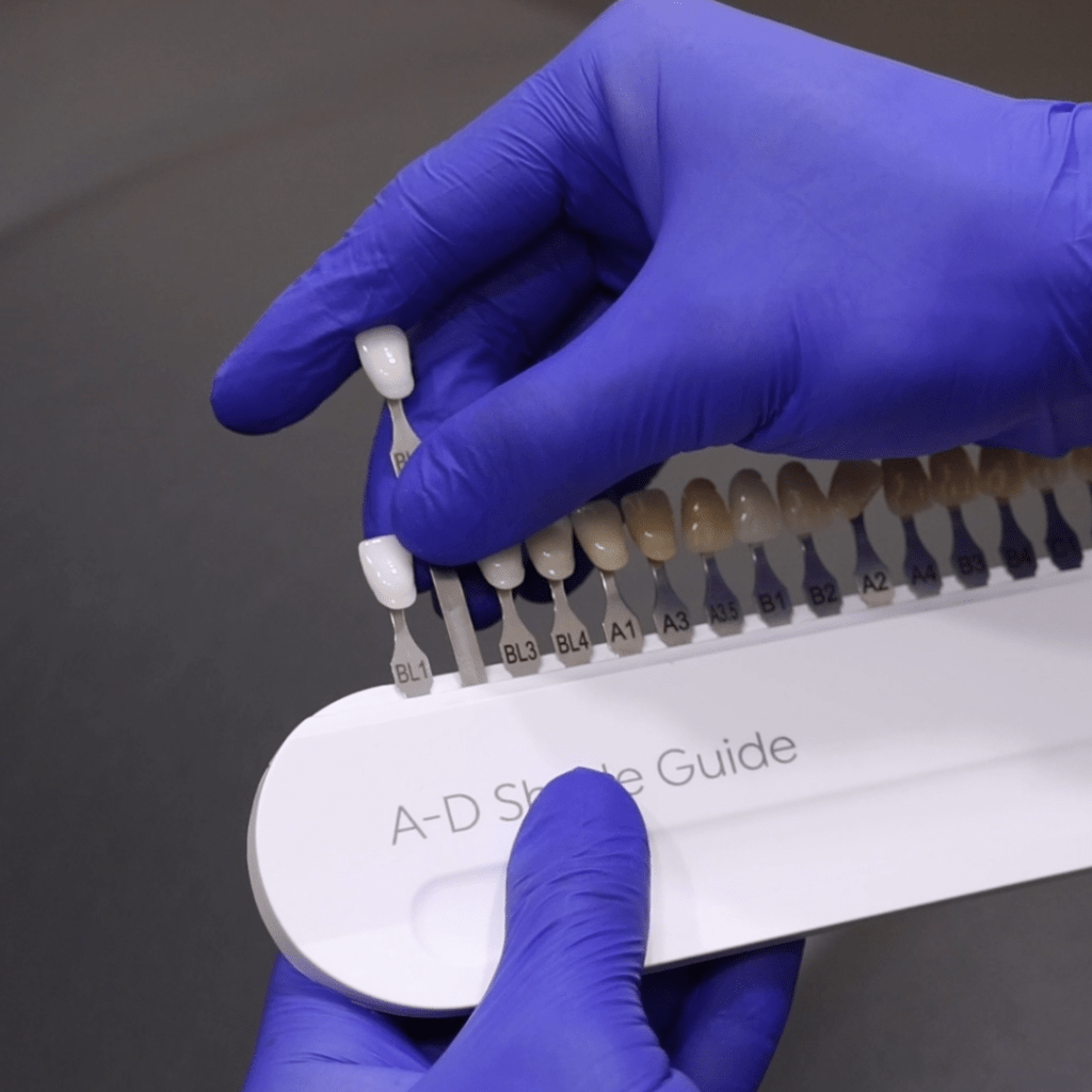 Composite Veneers in Parramatta
