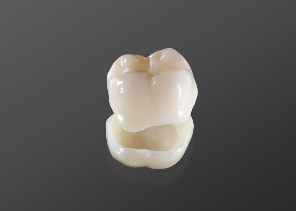 Dental crown fitted at Parramatta Dentistry