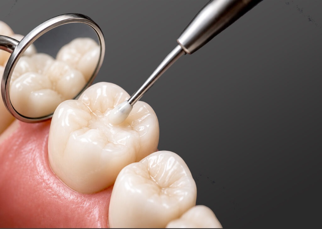 Tooth-coloured dental filling in Parramatta
