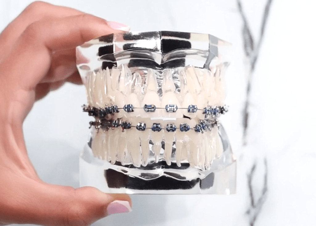 A close-up of a dental model showing upper and lower teeth fitted with traditional metal braces.