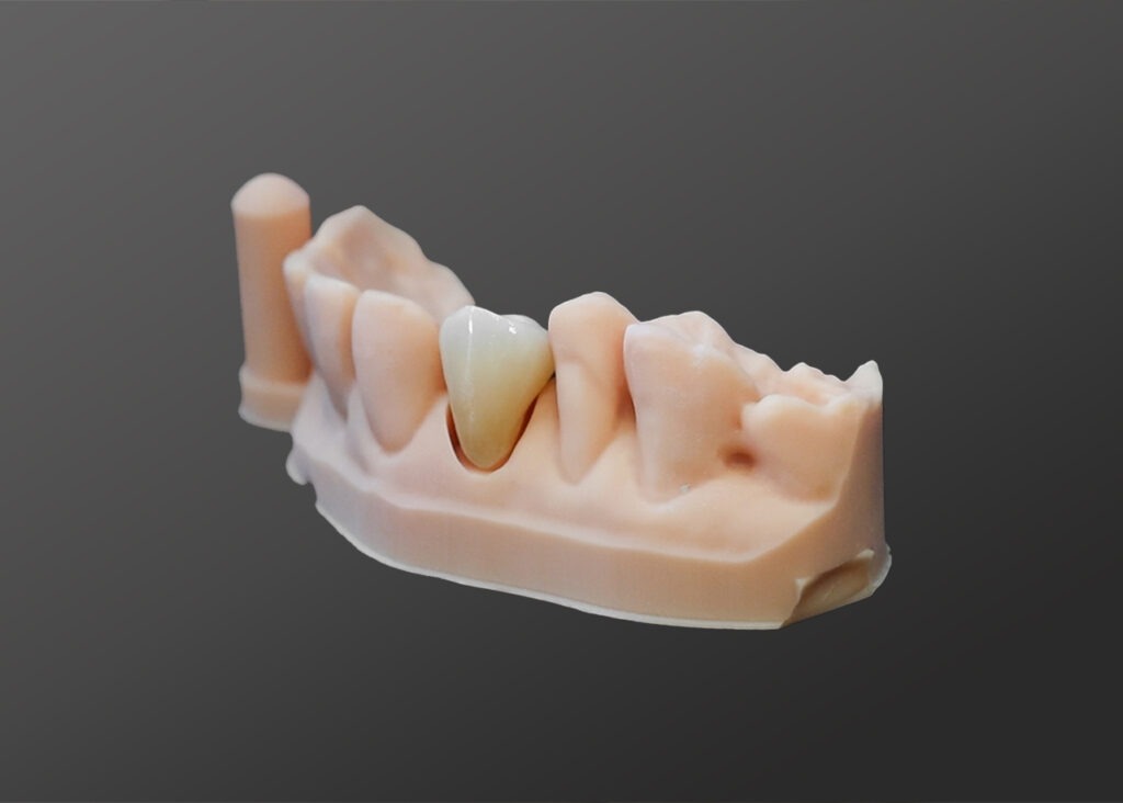 A dental model of a tooth showing the placement of a realistic porcelain crown over a prepared tooth structure.