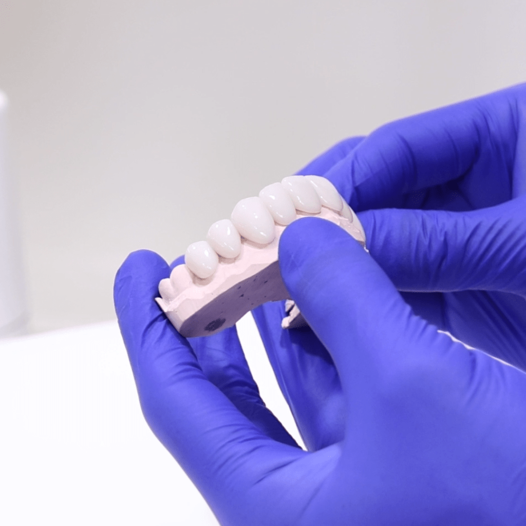Porcelain veneers model at North Sydney Dentistry