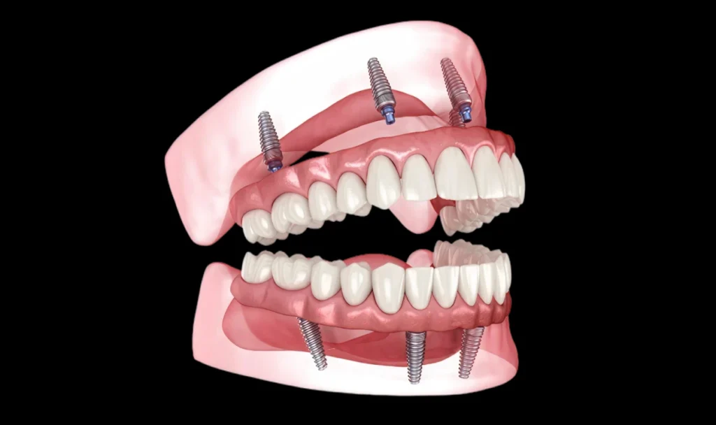 Full-arch teeth on dental implants