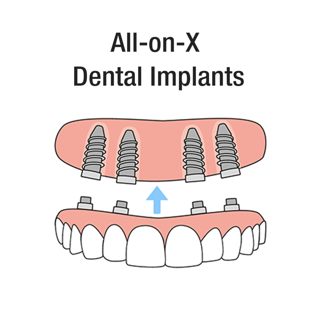 Diagram of All-on-X full-arch dental implants