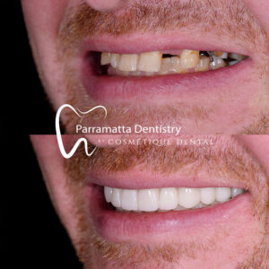 All-on-4 Dental Implants