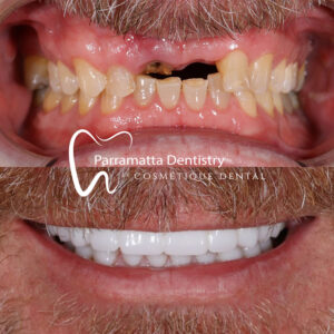 All-on-4 Dental Implants