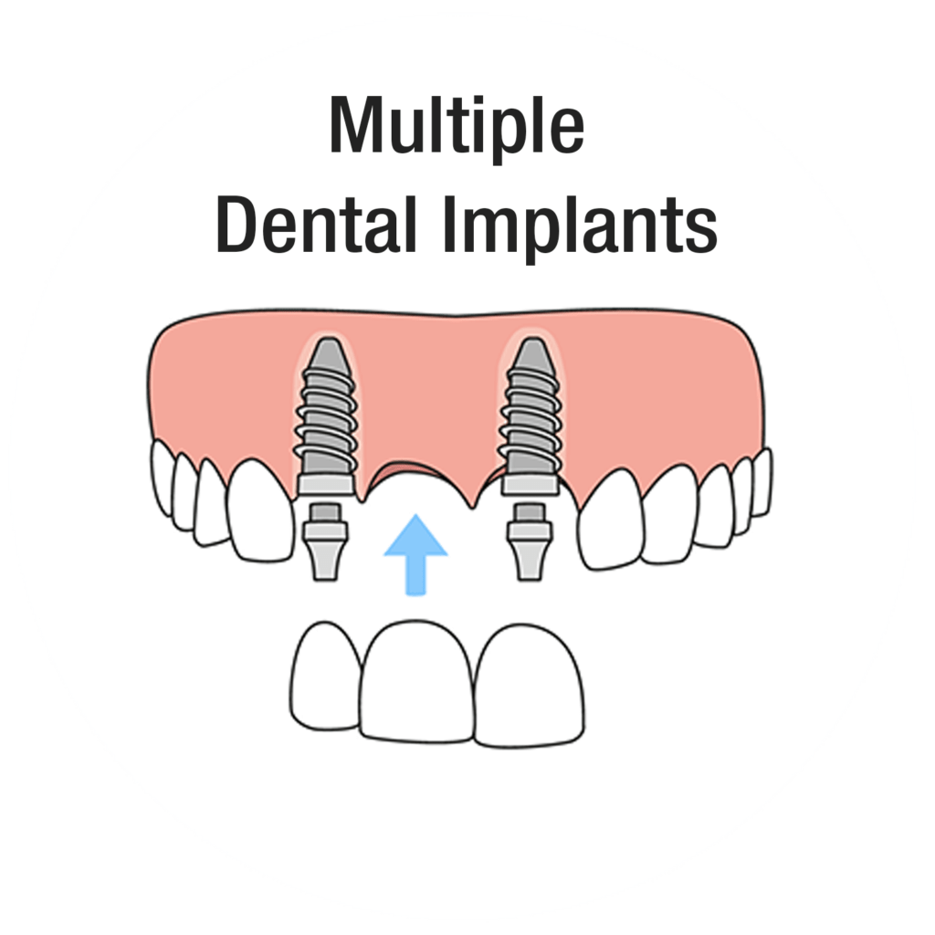 Diagram of multiple dental implants