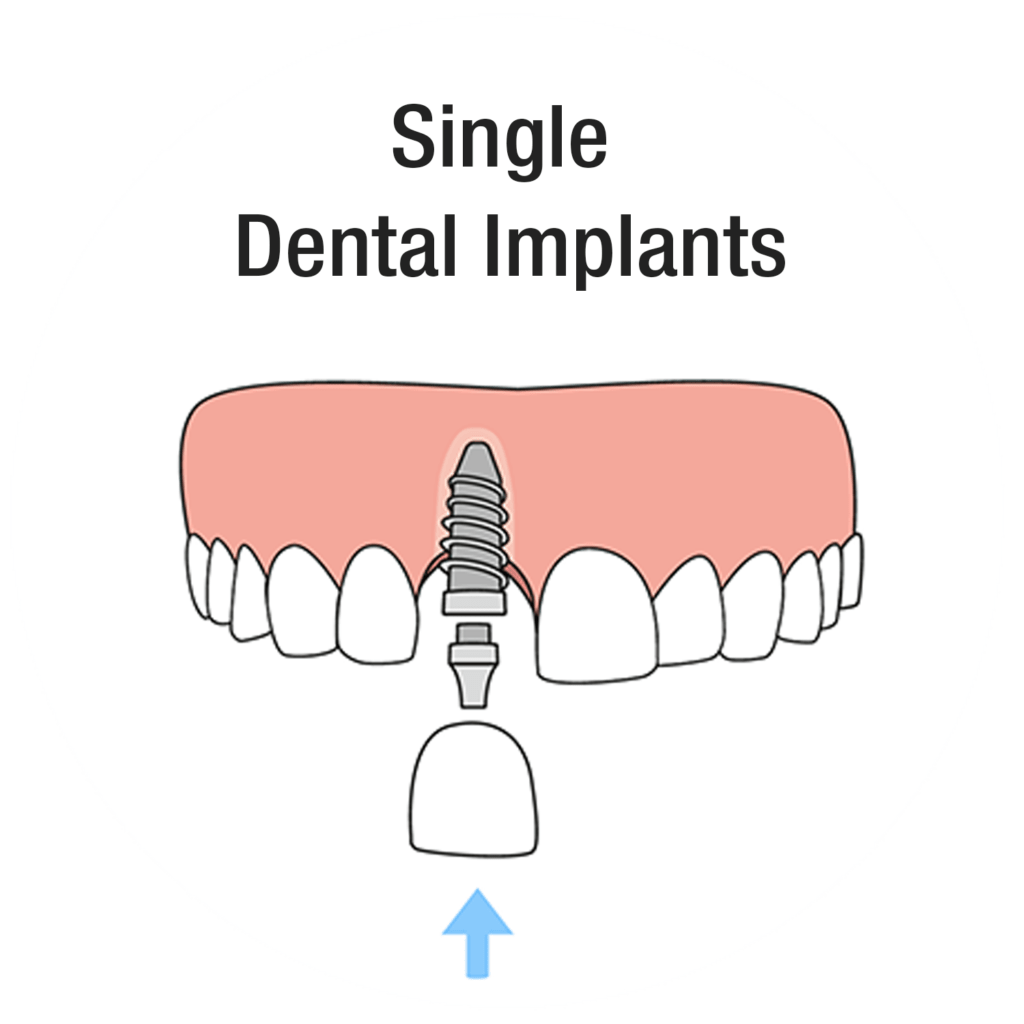 Diagram of a single dental implant